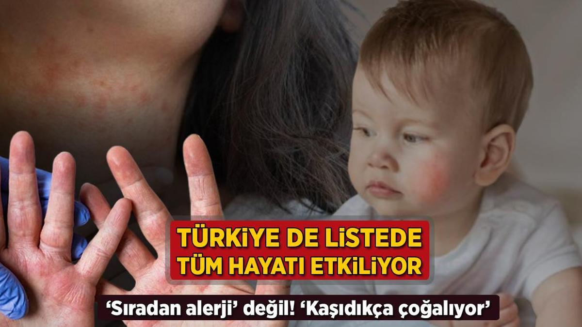 turkiye de listede tum hayati kotu etkiliyor siradan alerji degil kasidikca cogalir FEPUiXpB.jpg